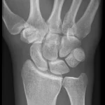 How to Read Wrist Xrays