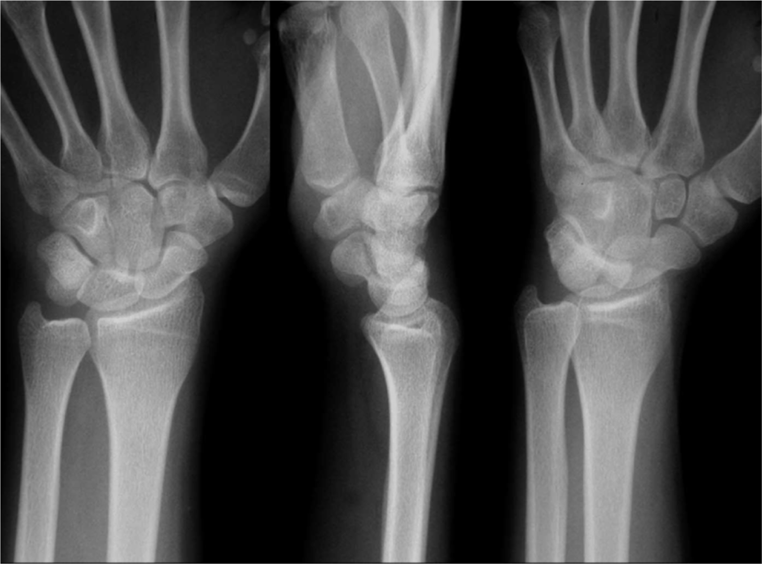 Normal Wrist X Ray Lateral