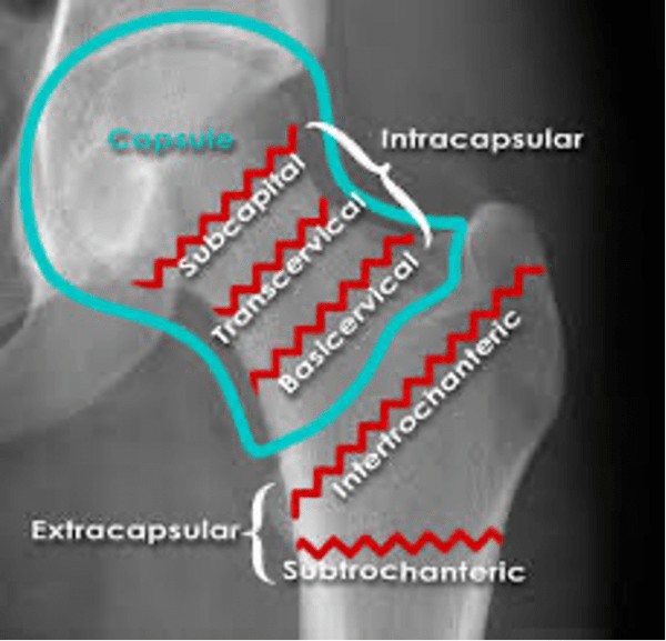 Basicervical Femoral Neck Fracture Management - Ortho Conditioning